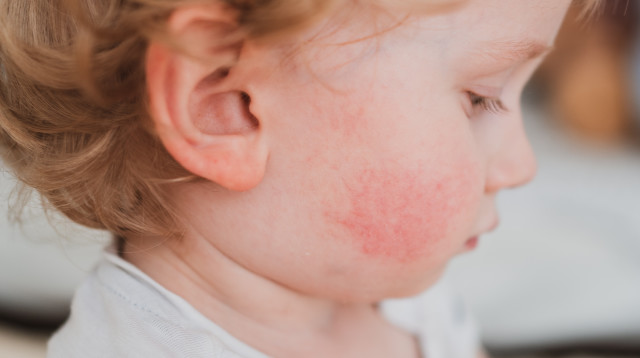 כל מה שצריך לדעת על זכויות לילדים עם אלרגיה למזון (צילום: envato)