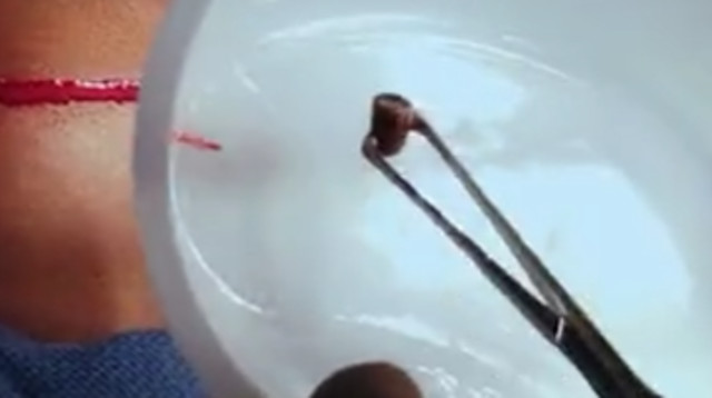 הקליע שהוצא מגבה של מיילס (צילום: צילום מסך פייסבוק)