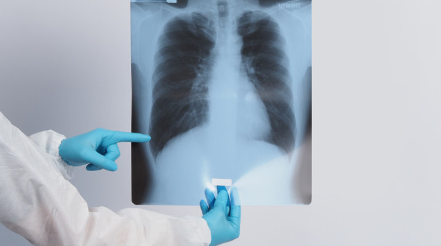 צילום ריאות, אילוסטרציה (צילום: אינגאימג')