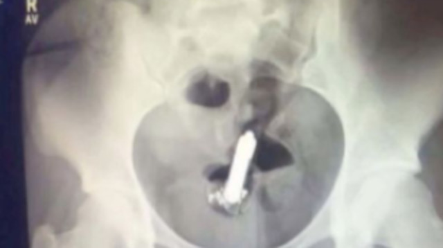 הוויברטור נתקע עמוק מדי, נזקקה לטיפול רפואי כדי לחלץ אותו (צילום: צילום מסך טיקטוק)