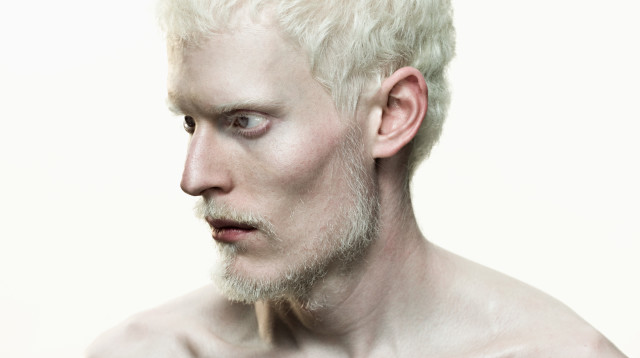 נרצח בידי אחיו רק בגלל היותו לבקן (צילום: אינג'אימג')