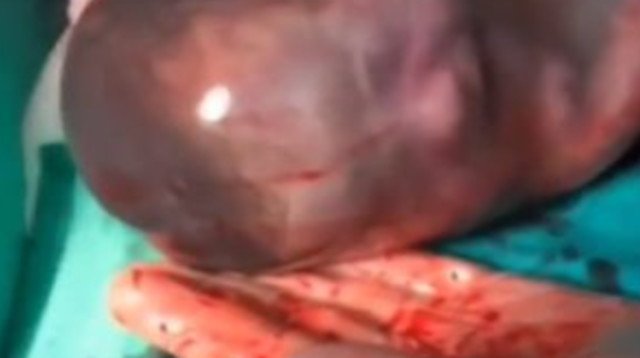 לידת "בתולת ים", אחת ל-80 אלף לידות (צילום: מתוך פייסבוק)