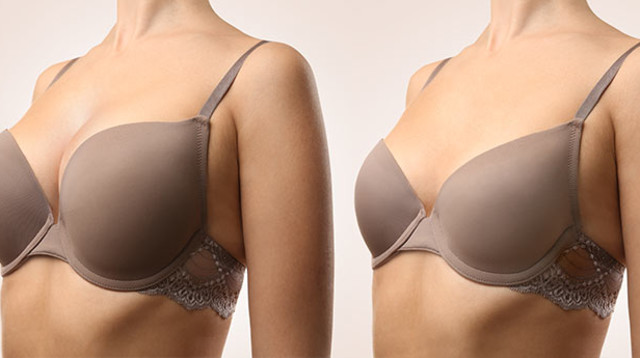 5 דברים לשים לב אליהם בתמונות "לפני ואחרי" של הגדלת חזה. (צילום: depositphotos)