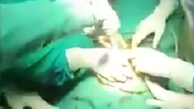 איך כוס מתכת הגיע לבטנו של האיש הזה? אפילו הוא טוען שהוא לא יודע (צילום: מתוך פייסבוק)