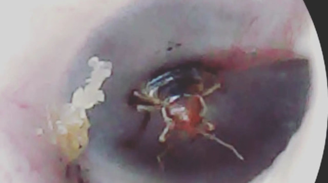 ג'וק בתעלת השמע (צילום: דוברות בית חולים לניאדו)