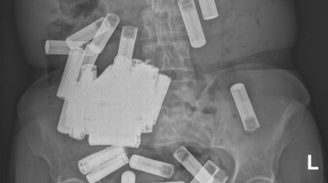 חריג: איך הגיעו 55 סוללות לבטנה של אישה בת 66? (צילום: מתוך פייסבוק)