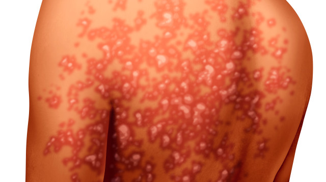 פסוריאזיס (אילוסטרציה) (צילום: אינג אימג')