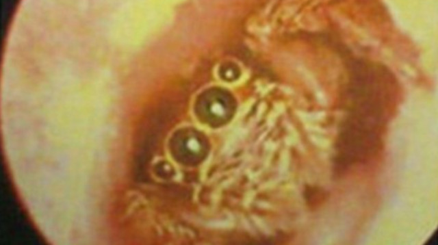 מזעזע! העכביש באוזנה של הצעירה (צילום: מתוך פייסבוק)