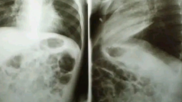 פעוט בלע סוללה והיא התפוצצה בתוך גופו וגרמה לו כוויות קשות (צילום: מתוך פייסבוק)