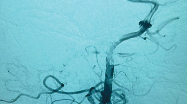 צילום הדמיה, בו ניתן לראות את החסימה באחד מעורקיה המוח (צילום: המרכז הרפואי לגליל)