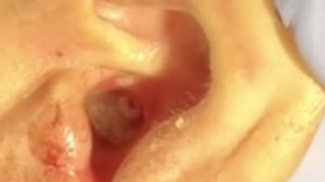 רימות זבובים עמוק באוזן של בן ה-64 (צילום: מתוך פייסבוק)