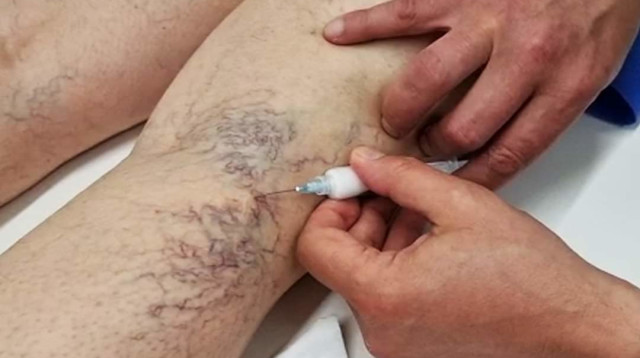 טיפול באי ספיקה ורידית (צילום: ד"ר איגור מנביץ')