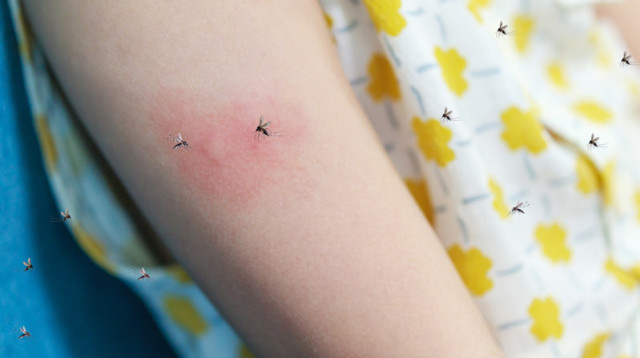 8 טיפים לטיפול באורטיקריה שחייב להכיר (צילום: FREEPIK)