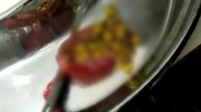 מזעזע! 328 אבנים נמצאו בכיס המרה של אישה (צילום: מתוך טיקטוק)