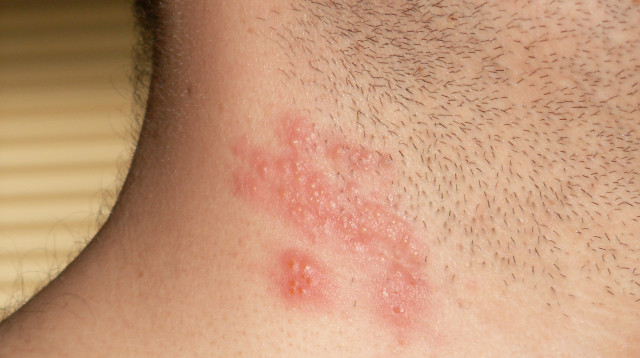 שלבקת חוגרת בצוואר (צילום: ויקיפדיה,CC BY-SA 3.0)