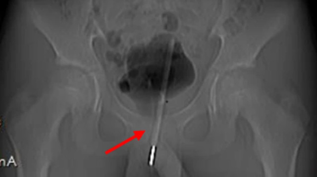 בן 12 החדיר מדחום לשופכה (צילום: מתוך פייסבוק)