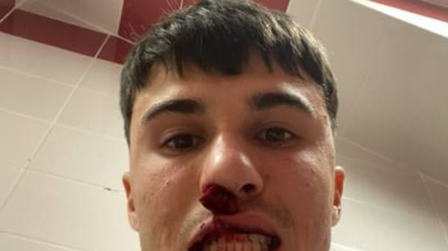 אלסנדרו ביאנקו שחקן פיורנטינה לאחר שהוכה על ידי אוהד סיבאספור (צילום: צילום מסך, האינסטגרם של אלסנדרו ביאנקו)