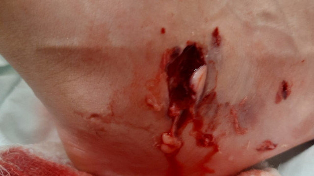 רגלה הפצועה של הנערה. "חשבה שהיא עומדת למות" (צילום: באדיבות המשפחה)