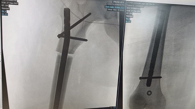 צעיר בן 19 מירושלים עבר בהצלחה ניתוח לקיצור רגל (צילום: בית החולים אסותא אשדוד)