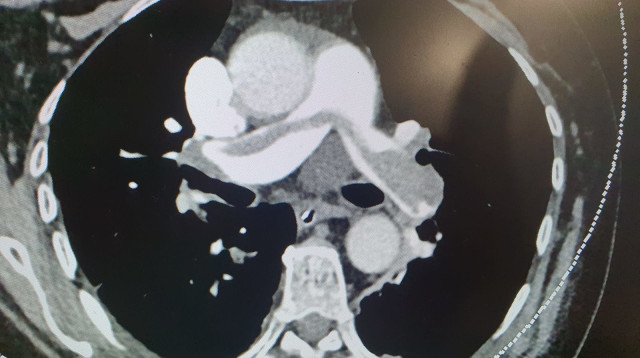 קטטר חדש השואב קרישי דם (צילום: דוברות שערי צדק)