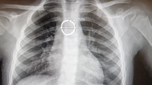 צילום הרנטגן בו נצפתה הטבעת (צילום: באדיבות בית החולים הלל יפה)