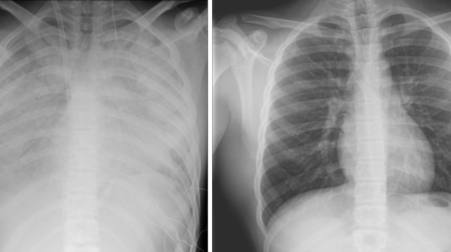 ריאותיו של הנער לעומת ריאות תקינות (צילום: דוברות שניידר)