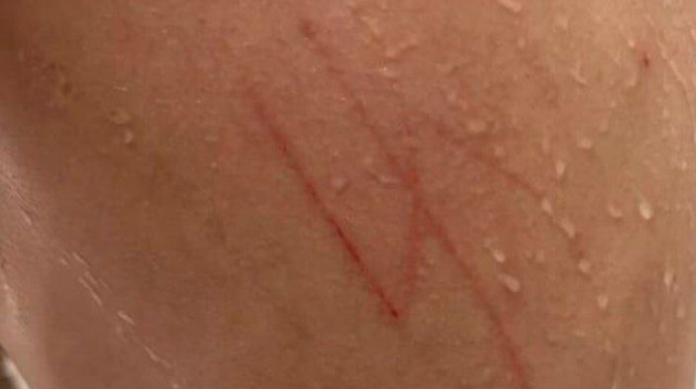 תקפו אותו קשות וחרטו צלב קרס על גבו (צילום: מתוך פייסבוק)