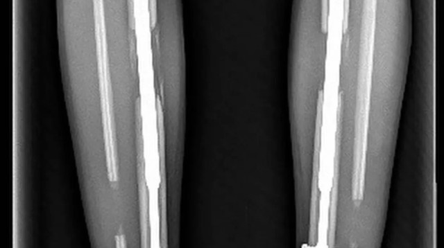 ניתוח להארכת הרגליים (צילום: מתוך פייסבוק)