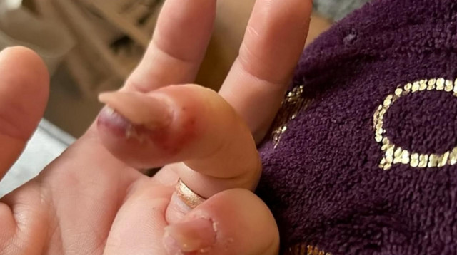 הציפורניים התנתקו ממקומן (צילום: מתוך פייסבוק)