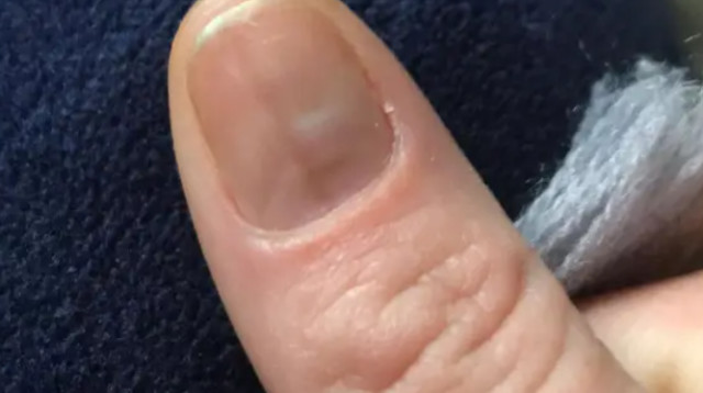 חשבה שזו בסך הכל פטרת בציפורן - מה שהתברר כסרטן קטלני (צילום: מתוך טיקטוק)