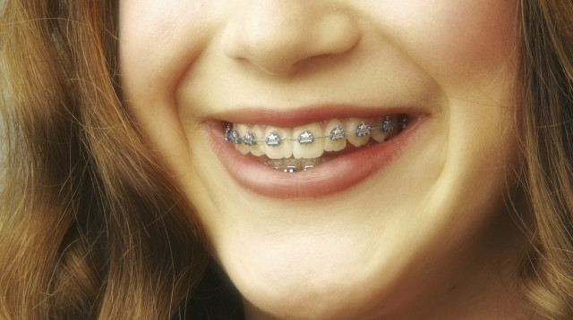 גשר בשיניים, אילוסטרציה (צילום: אינגאימג')