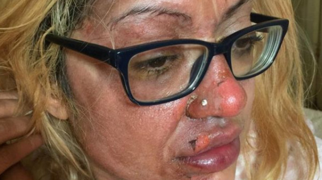 מזעזע: סבלה מכוויות קשות בגלל טיפ שמצאה ברשת (צילום: רשתות חברתיות)