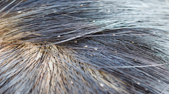 כינים, אילוסטרציה (צילום: אינגאימג')