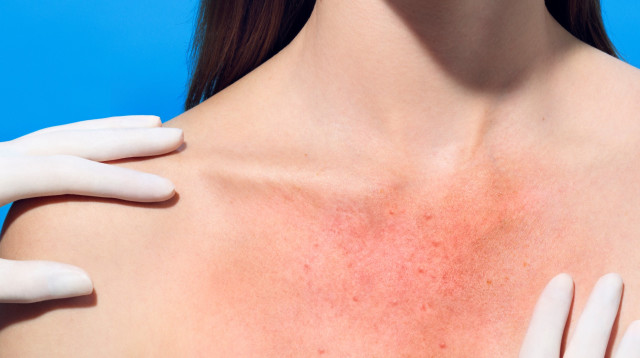 סרטן העור. גילוי מוקדם יכול להציל חיים. צילום באדיבות לה רוש פוזה (צילום: יחצ חול)