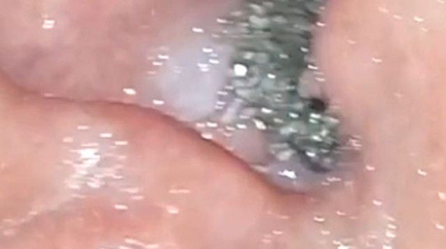 אוזנו של ולדמיר דקנטי, נאלץ לעבור ניתוח (צילום: מתוך פייסבוק)