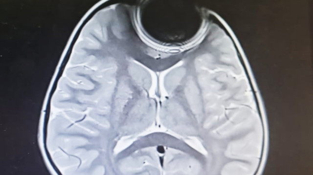 ההפרעה המגנטית אותה יצרה הסוללה בצילום הדימות (צילום: הקריה הרפואית רמב"ם)