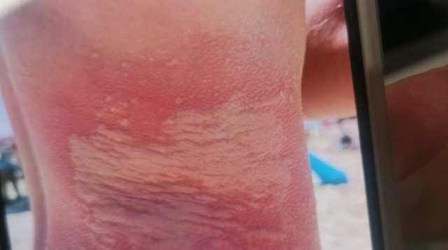 הצריבה בגוף הצעיר (צילום: אסותא אשדוד)