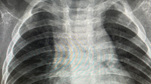 הסיכה בגופו של הפעוט (צילום: דוברות "אסותא" אשדוד)