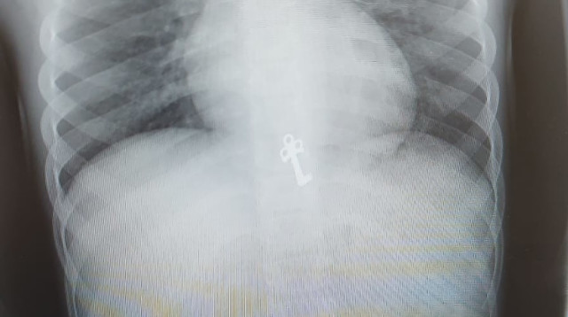 הצילום שנערך לילד, טרם הטיפול הפולשני  (צילום: דוברות מרכז פרנקל לרפואה דחופה)