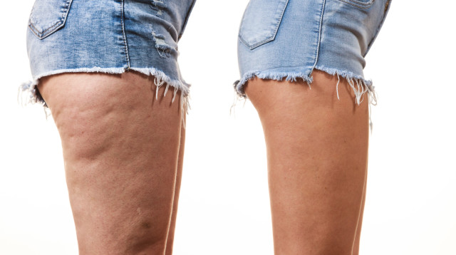 צלוליט, אילוסטרציה (צילום: אינגאימג')