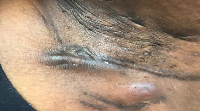 בית שחי של חולה במחלת העור הידרדניטיס ספורטיבה (צילום: ד"ר עלי מואין)