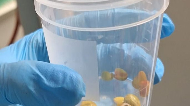 הגוף הזר שהוצא (צילום: דוברות ברזילי)