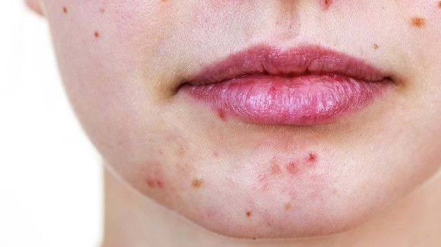 אקנה, אילוסטרציה (צילום: אינגאימג')