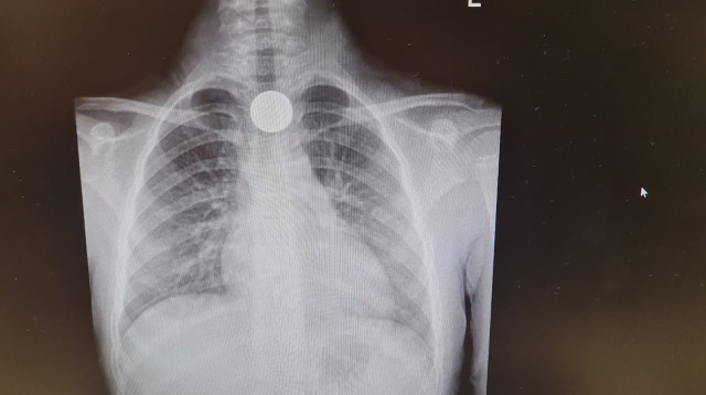 המטבע שבלעה הילדה (צילום: המרכז הרפואי ברזילי)