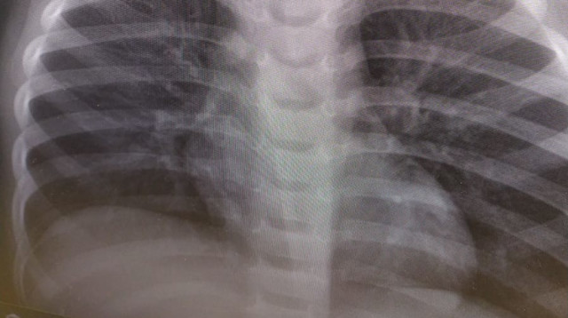 סוללת הכפתור שנבלעה (צילום: דוברות הדסה)