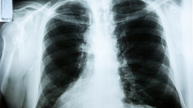 צילום רנטגן, אילוסטרציה (צילום: אינג'אימג')