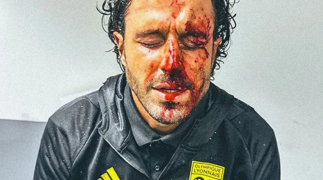 פאביו גרוסו מאמן ליון לאחר שנפצע מבלוקים שנזרקו על האוטובוס מצד אוהדי מארסיי (צילום: צילום מסך, מתוך טוויטר)