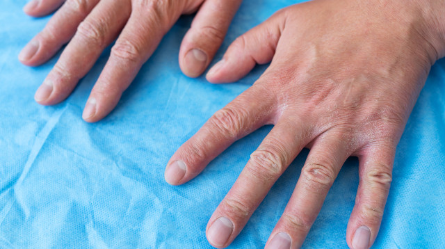 זה הקשר בין חרדה וסטרס למחלת הפסוריאזיס (צילום: אינג'אימג')