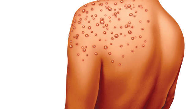 עגבת (צילום: אינגאימג')