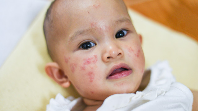 חצבת. מפריחה ועד נזק נוירולוגי קשה (צילום: אינגאימג')